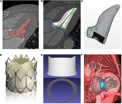 Patient-specific fluid simulation of transcatheter mitral valve replacement in mitral annulus calcification